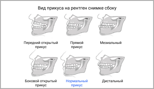 Исправление неправильного прикуса у взрослых | ЭлитДентал М.